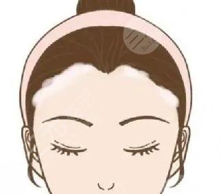 發(fā)際線種植