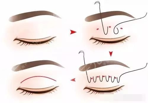 米蘭許智醫(yī)生雙眼皮怎么樣