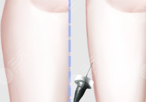 抽脂大腿大約需要多少錢