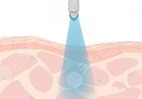 縮小毛孔的醫(yī)美項目