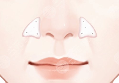 假體隆鼻要多少錢(qián)