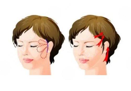 做拉皮手術(shù)能保持多少年