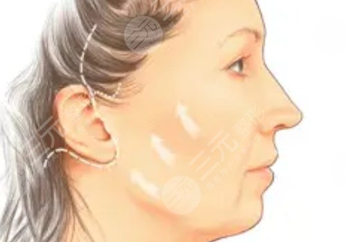 做拉皮手術(shù)能保持多少年