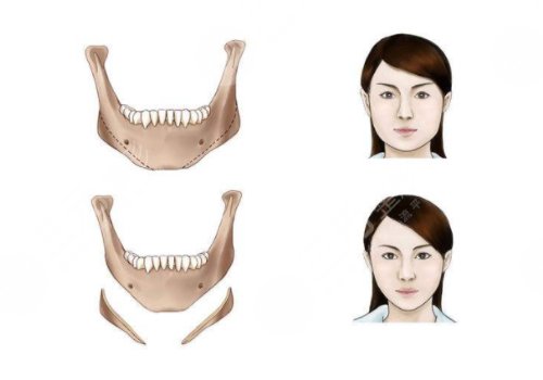 下頜骨整形術(shù)一般費(fèi)用