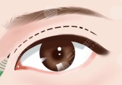 王彥進(jìn)雙眼皮手術(shù)價(jià)格是多少