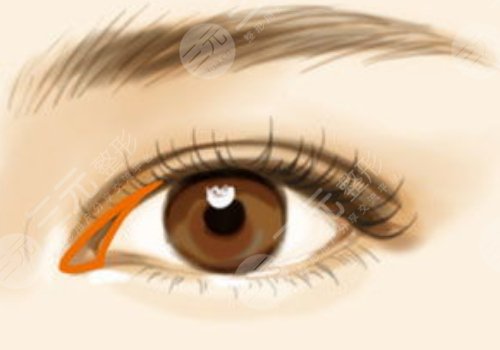 恢復快的雙眼皮做法是什么