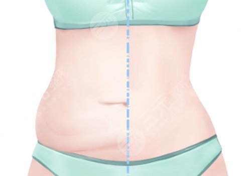 腰部環(huán)形吸脂手術(shù)大概多少錢