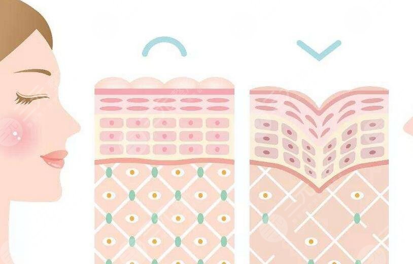 頸紋是打膠原還是打嗨體