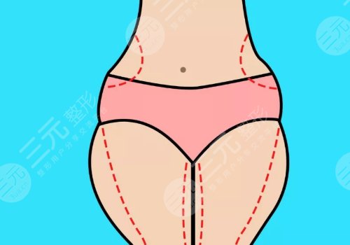 腰腹吸脂多久可以側身睡覺