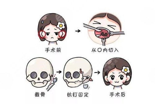 下頜骨手術費用