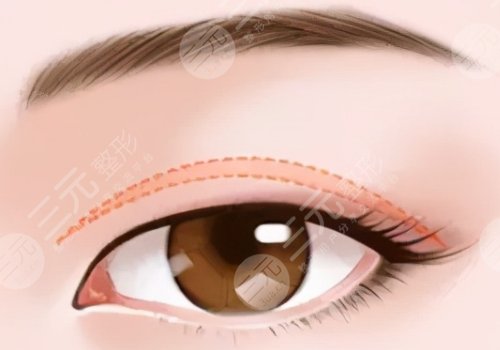 全切雙眼皮可以二次修復(fù)嗎