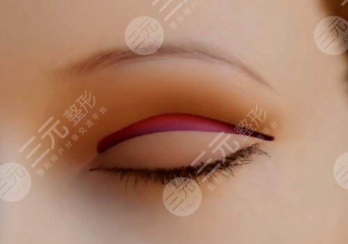 全切雙眼皮可以二次修復(fù)嗎