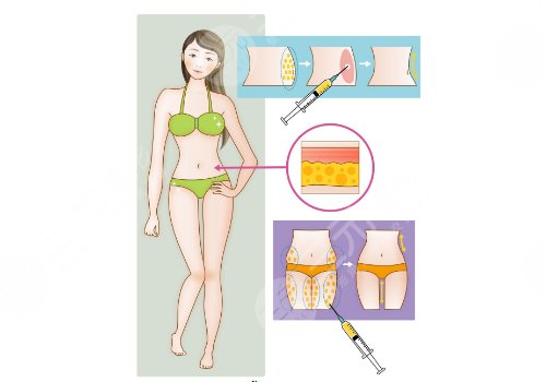 大腿吸脂減肥多少錢
