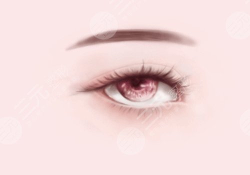 馬希達(dá)醫(yī)生雙眼皮案例