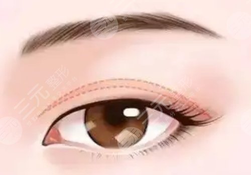 修復(fù)雙眼皮的價格