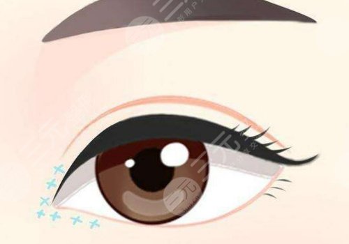 割雙眼皮第七天恢復(fù)圖