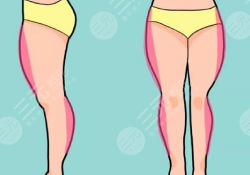 大腿抽脂的價(jià)格