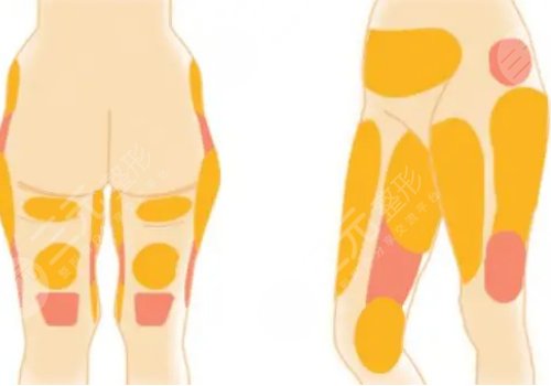 大腿抽脂的價(jià)格