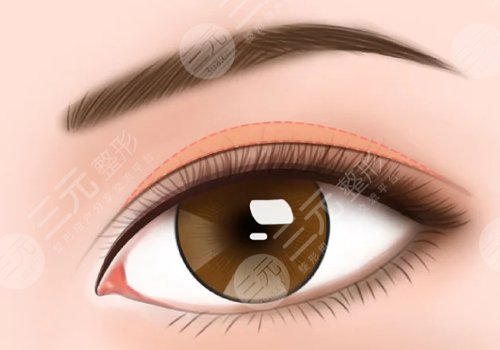 埋線雙眼皮一個(gè)寬一個(gè)窄怎么修復(fù)