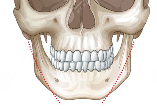 下頜骨矩形切除術(shù)多少錢
