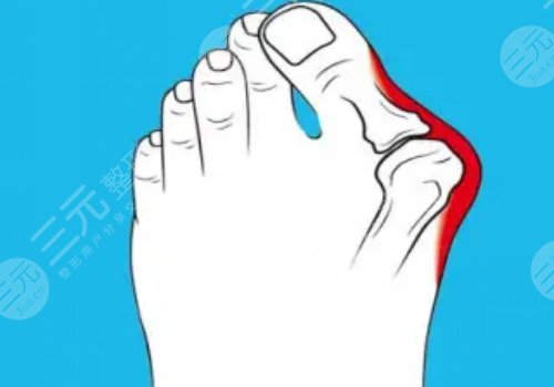 北京圣嘉新拇外翻