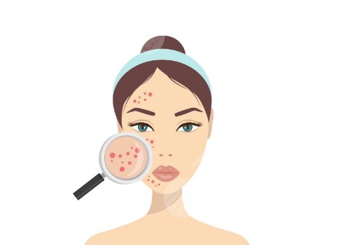 四會(huì)紫盈美容院去痘坑怎么樣