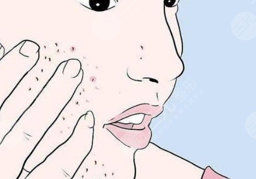 四會(huì)紫盈美容院去痘坑怎么樣