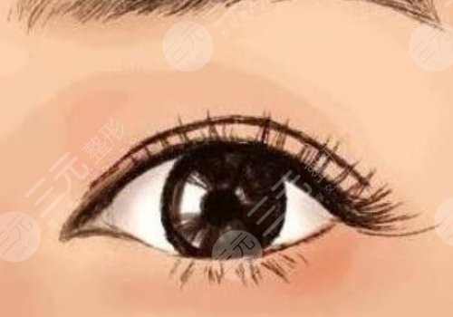 雙眼皮二次修復(fù)要錢不