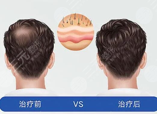 江蘇省中醫(yī)院植發(fā)多少錢(qián)?