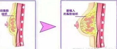 隆胸項(xiàng)目