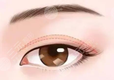 雙眼皮