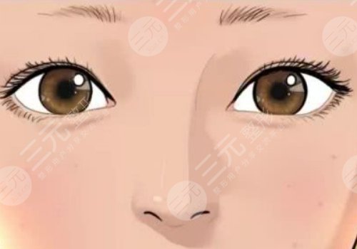 曹衛(wèi)剛醫(yī)生雙眼皮修復怎么樣