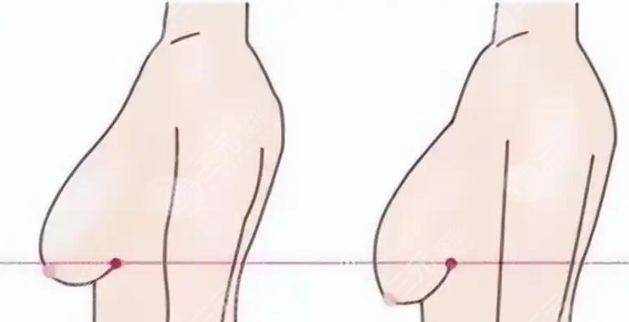 乳房下垂矯正