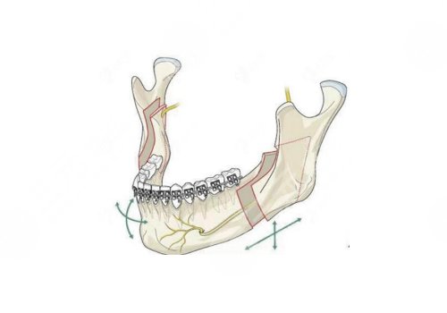 中山大學(xué)附屬口腔醫(yī)院做正頜手術(shù)怎么樣