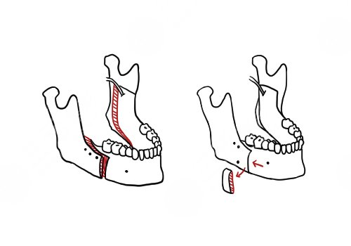 中山大學(xué)附屬口腔醫(yī)院做正頜手術(shù)怎么樣