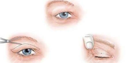 雙眼皮修復(fù)