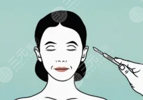 王志堅醫(yī)生小拉皮提升做的怎么樣