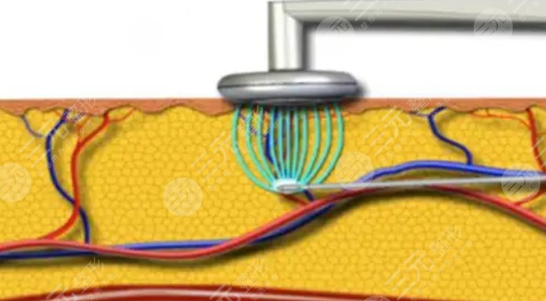 bodytite射頻溶脂