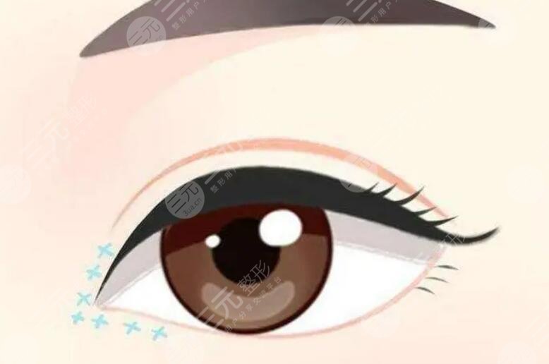 雙眼皮修復(fù)