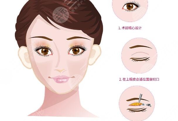 雙眼皮修復(fù)