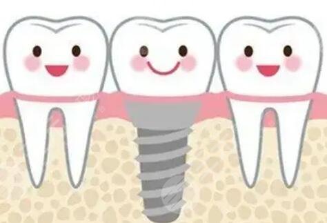 牙齒種植
