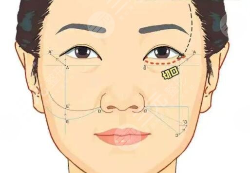面部提升