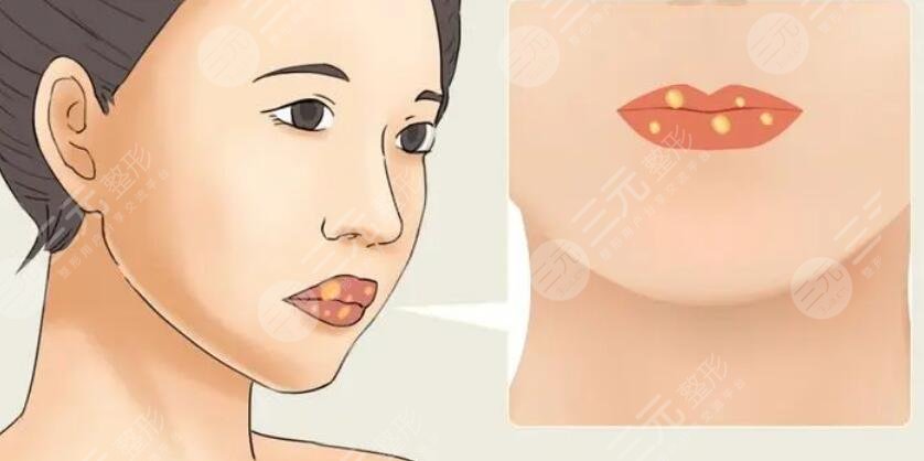 唇部整形