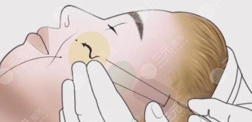 內(nèi)窺鏡除皺