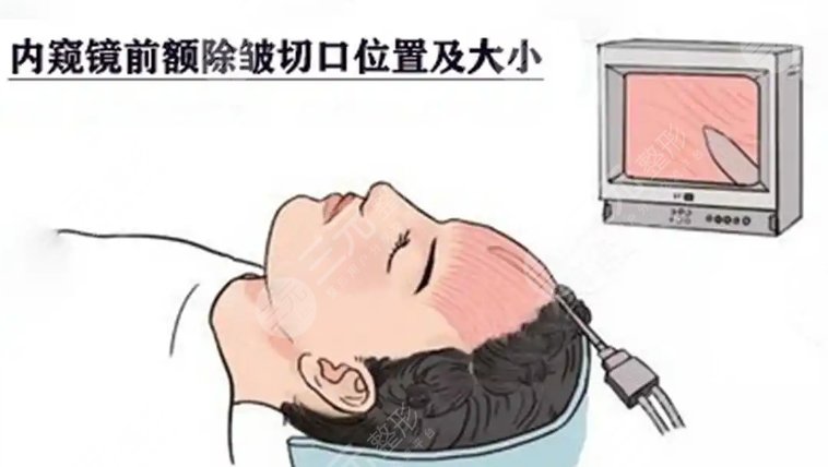 內(nèi)窺鏡除皺