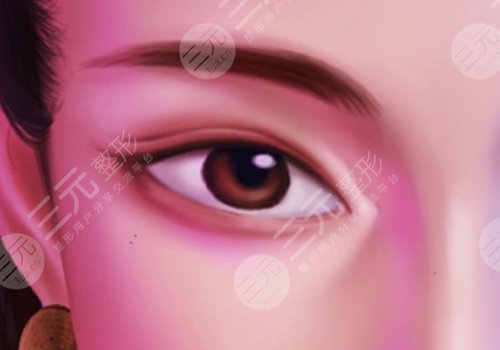 上海六院雙眼皮埋線怎么樣