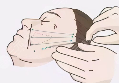 天津伊美爾做拉皮手術(shù)哪個(gè)醫(yī)生好？袁志瑋醫(yī)生值得信賴！