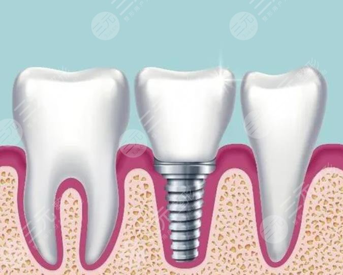 牙齒種植