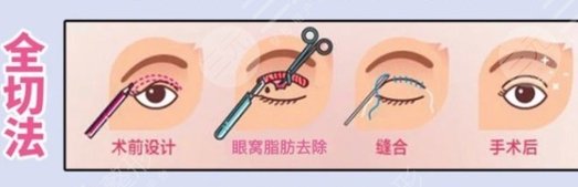 雙眼皮修復(fù)