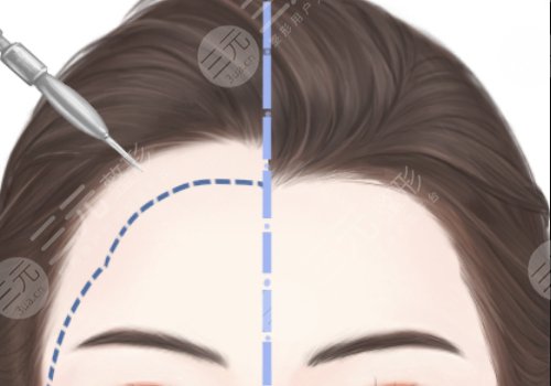 蘭州植發(fā)正規(guī)醫(yī)院排名